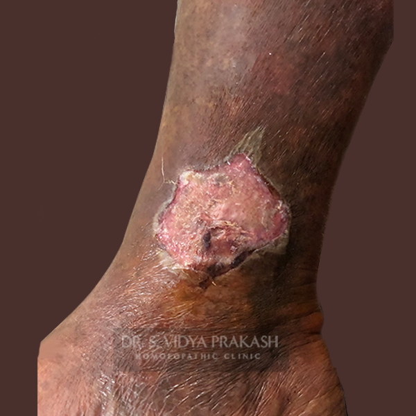Non-Healing Ulcers
