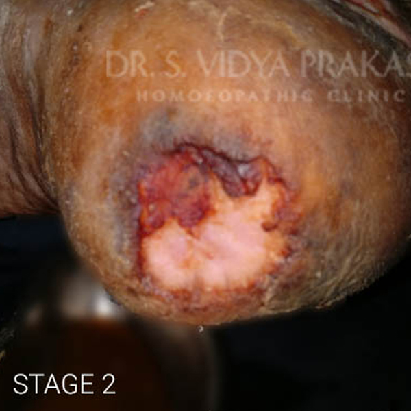 Non-Healing Ulcers